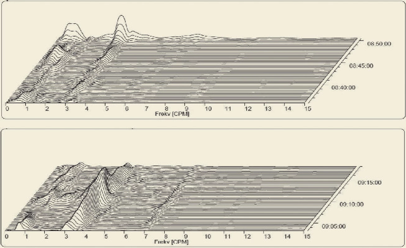 Spektrální analýza dominantní frekvence (v cyklech za minutu).
Fig. 4. Running spectral analysis of dominant frequency (cycles per minute).