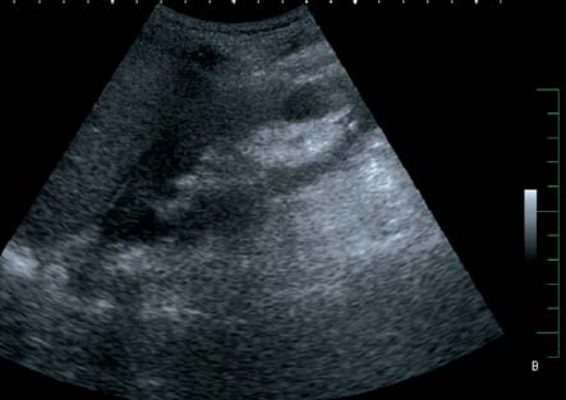 Sonografický obraz úplné reparace nálezu na pravé ledvině
Fig. 3. Complete restoration of finding in right kidney seen in ultrasound