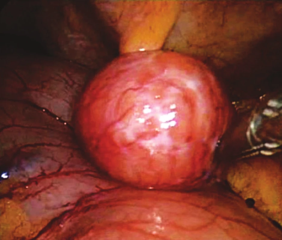 Peroperační snímek GIST žaludku
Fig. 1. Intraoperative view of gastric GIST