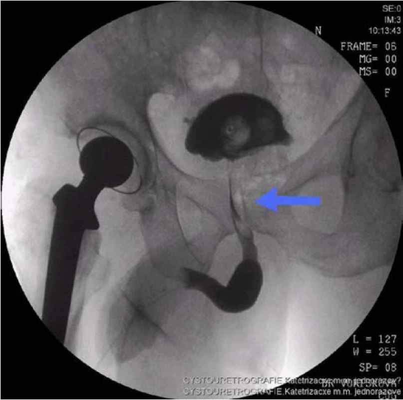 Cystouretrogram – defekt kontrastu v prostatické uretře
Fig. 1. Cystourethrogram – contrast defect of the prostatic urethra