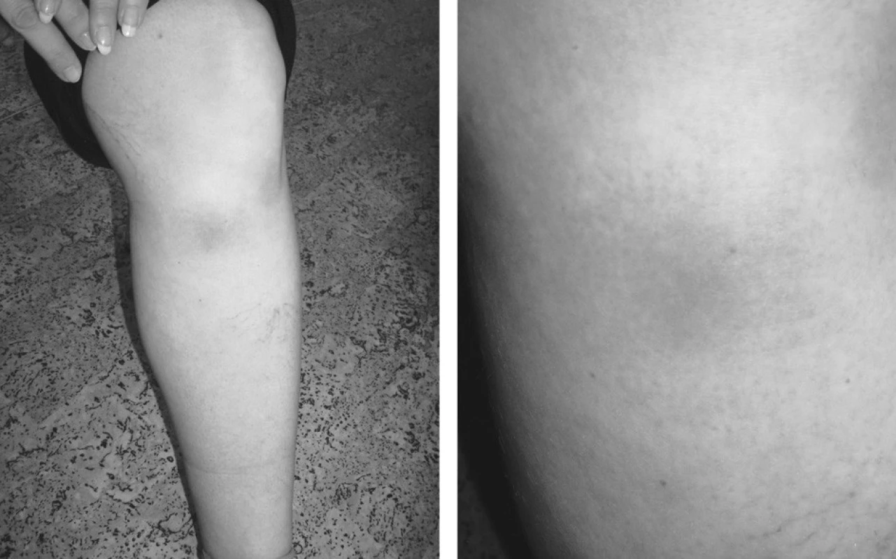 U 46leté ženy se po léčbě anginy lacunaris Amoclenem objevuje erythema nodosum na dolních končetinách. Ústup bez léčby během 2 týdnů.