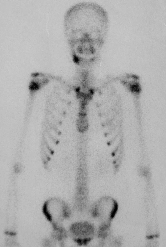 Kontrolní scintigrafie skeletu po 2 letech.