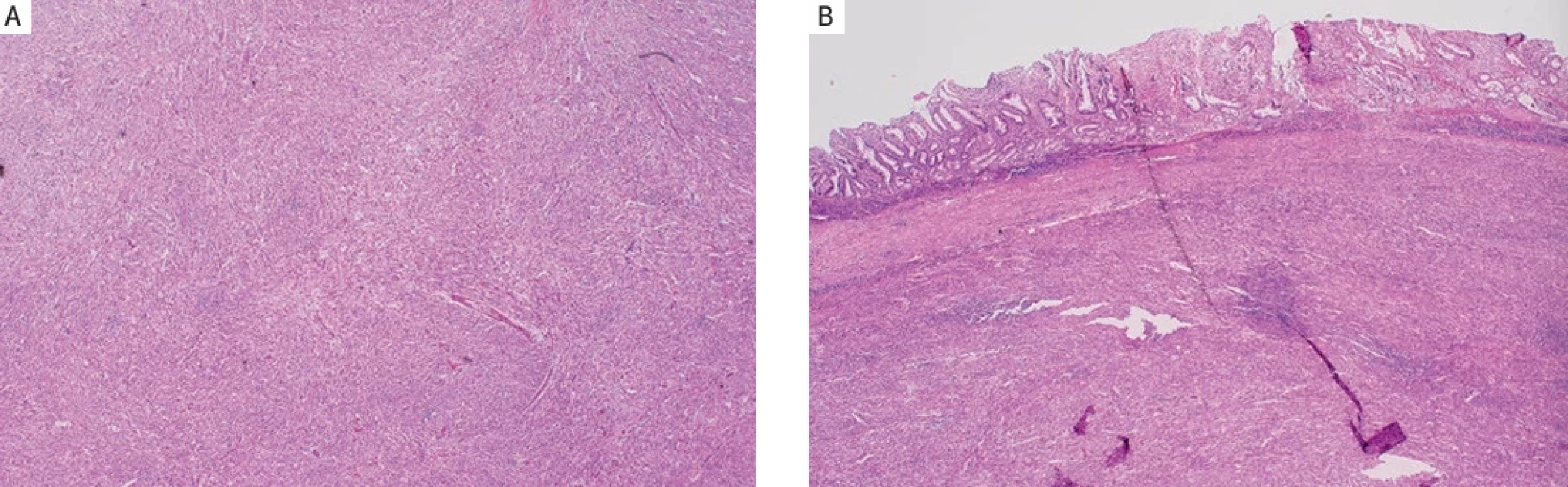  Pathological evaluation of the tumor (hematoxylin-eosin staining, 40×). A) The mass was characterised by a proliferation of  spindle cells. B) Spindle cell tumours extended into the mucosal layer.  Patologické hodnocení nádoru (barvení hematoxylin-eozin, 40×). A) Hmota byla charakterizována proliferací vřetenových  buněk. B) Vřetenobuněčné tumory zasahovaly do slizniční vrstvy.