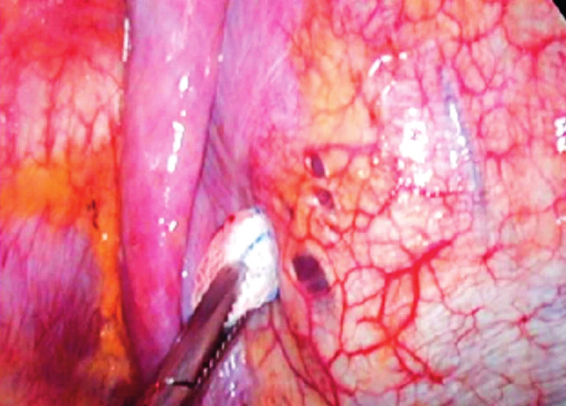 Peroperační nález tří malých otvorů v pars membranacea endometriózy, ale bývají označovány také jako bránice, které jsou spojovány s diagnózou katameniálního PNO