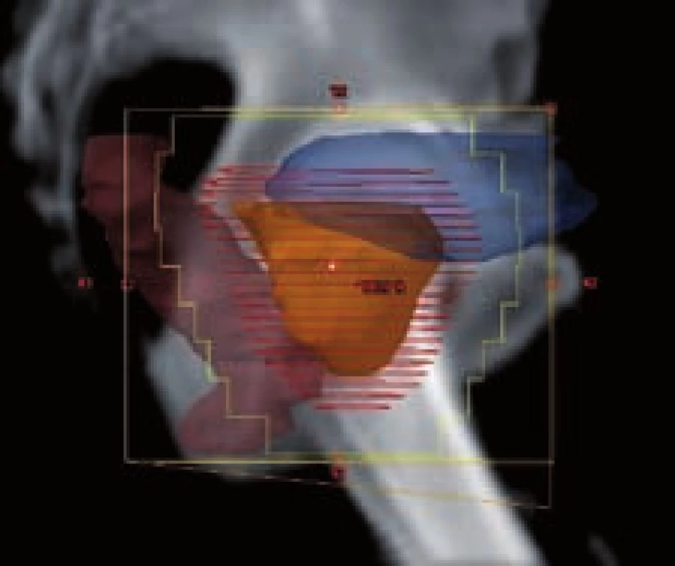 Cílový objem a rizikové orgány v BEV projekci
Fig. 2 Target volume and organs at risk in the BEV projection