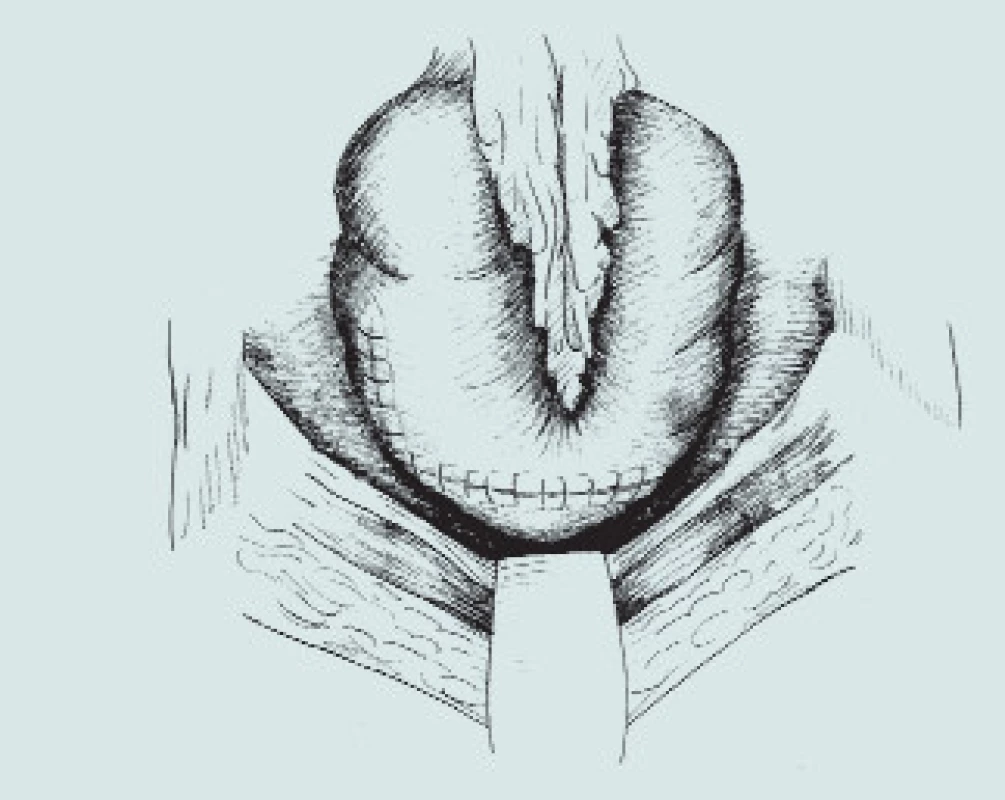 Patch-cystoplastika s použitím colon ascendens.
(A – resekční linie močového měchýře a segmentu střeva, B – příprava detubularizovaného segmentu colon, C – sutura okrajů střevního segmentu, D – vytvoření kupole m.m., E – uzavření plastiky nízkotlakého močového měchýře)