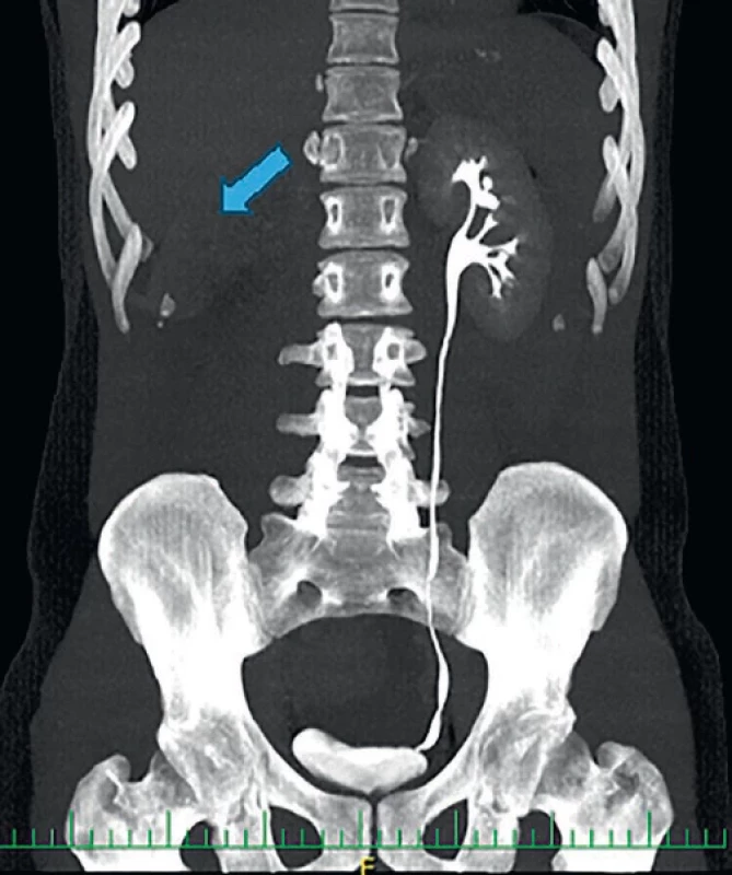 CT rekonstrukce urografické fáze – úplný výpadek funkce pravé ledviny. CT reconstruction of urographic phase – complete loss of right kidney function.