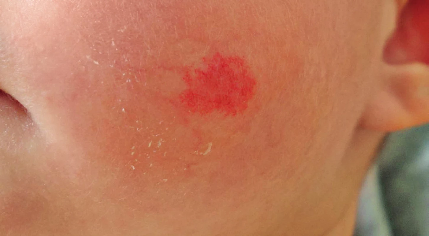 Obr. 11. Reziduum po léčbě propranololem vhodné k laserové terapii.
Fig. 11. Residue after propranolol therapy indicated for laser treatment.
