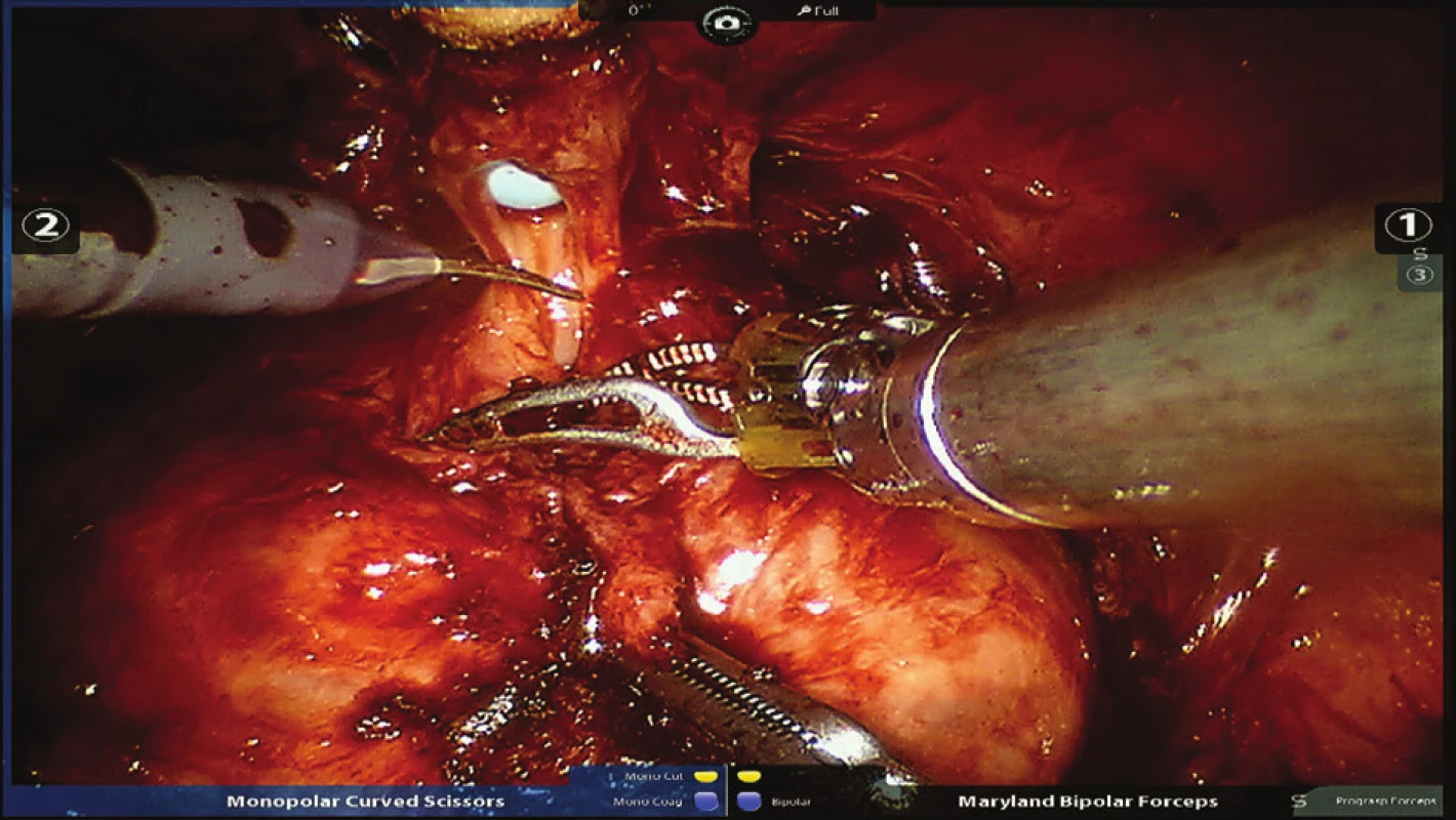 Přerušení uretry těsně pod apexem prostaty
Fig. 6: Interruption of the urethra just below the apex of the prostate