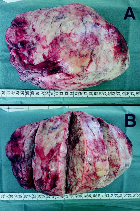 Makrofotografia obrovského solitárneho tumoru po jeho odstránení z pravej hrudníkovej dutiny (A – pred narezaním; B – po narezaní)
Fig. 3. Macro photography of the large solitary tumor following its removal from the right thoracic cavity (A – pred narezaním; B – po narezaní)