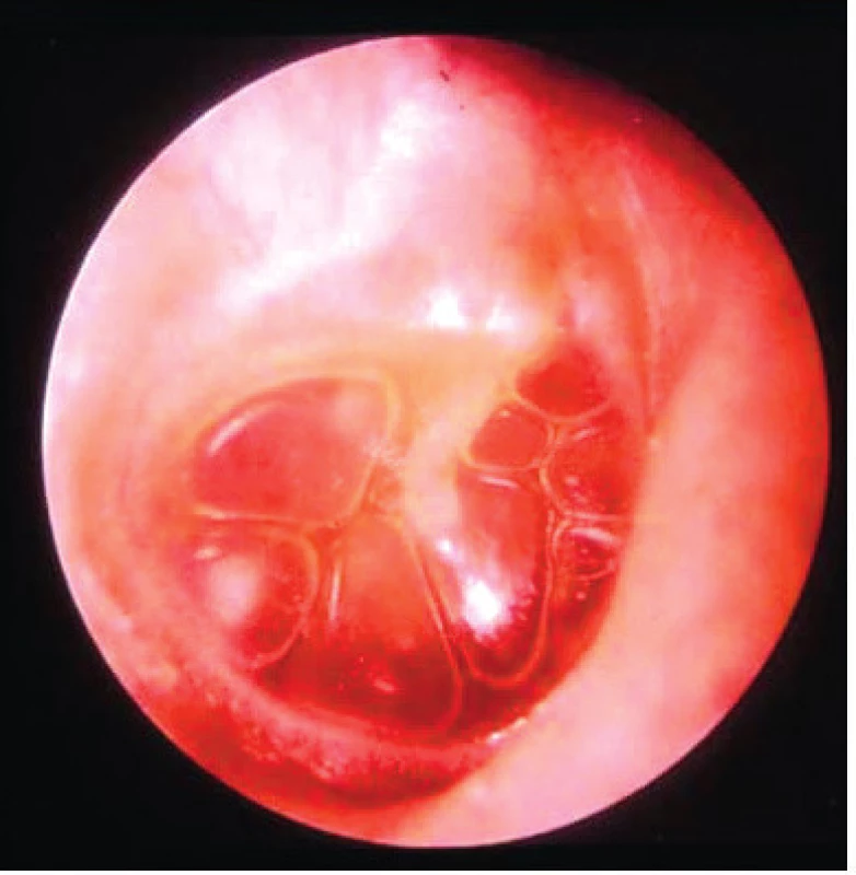 Chronický sekretorický zánět – bubliny vzduchu v tekutině v dutině bubínkové.
Fig. 2. Otitis media with effusion – air buble in fluid in the tympanic cavity.