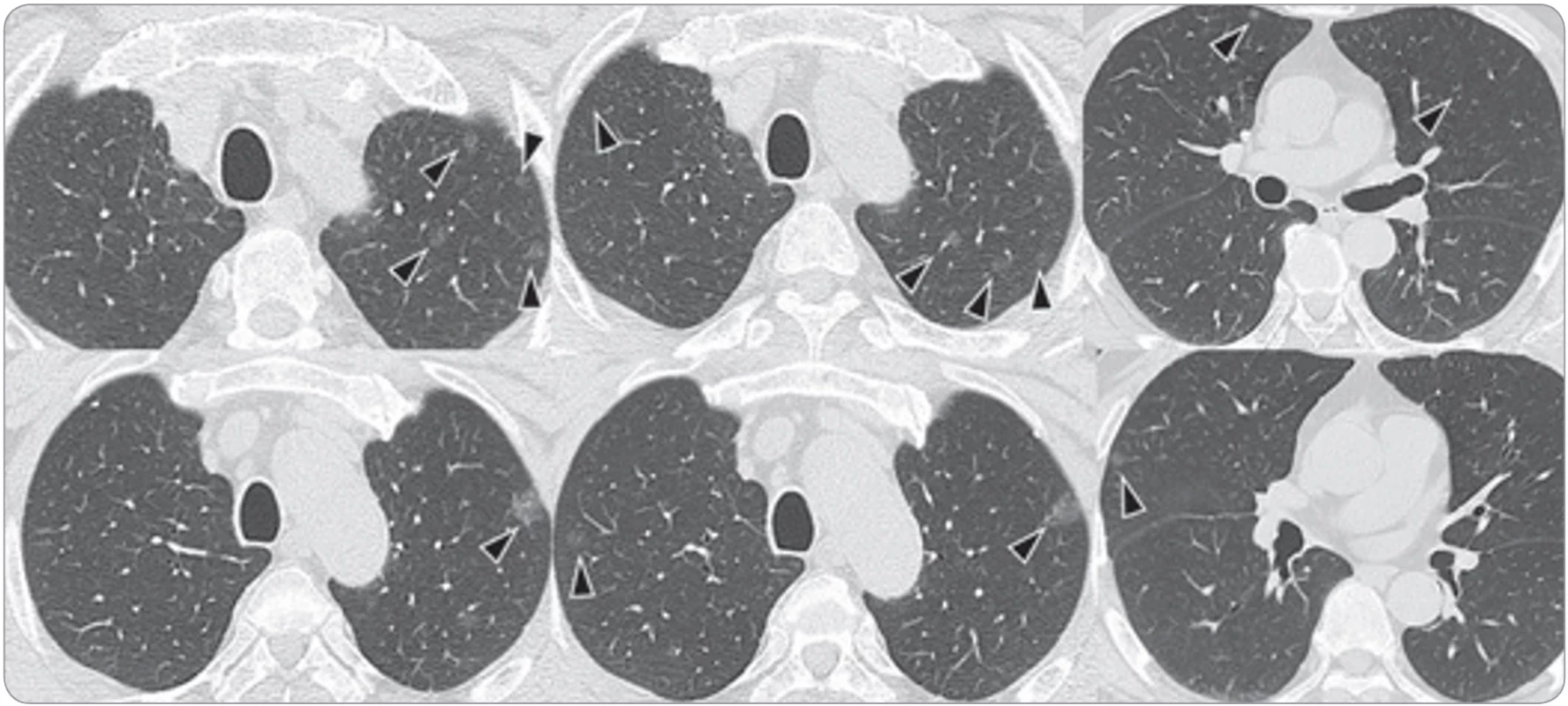 A chest CT scan showed numerous ground-glass opacity (GGO) nodules of various sizes in both lungs (arrows).