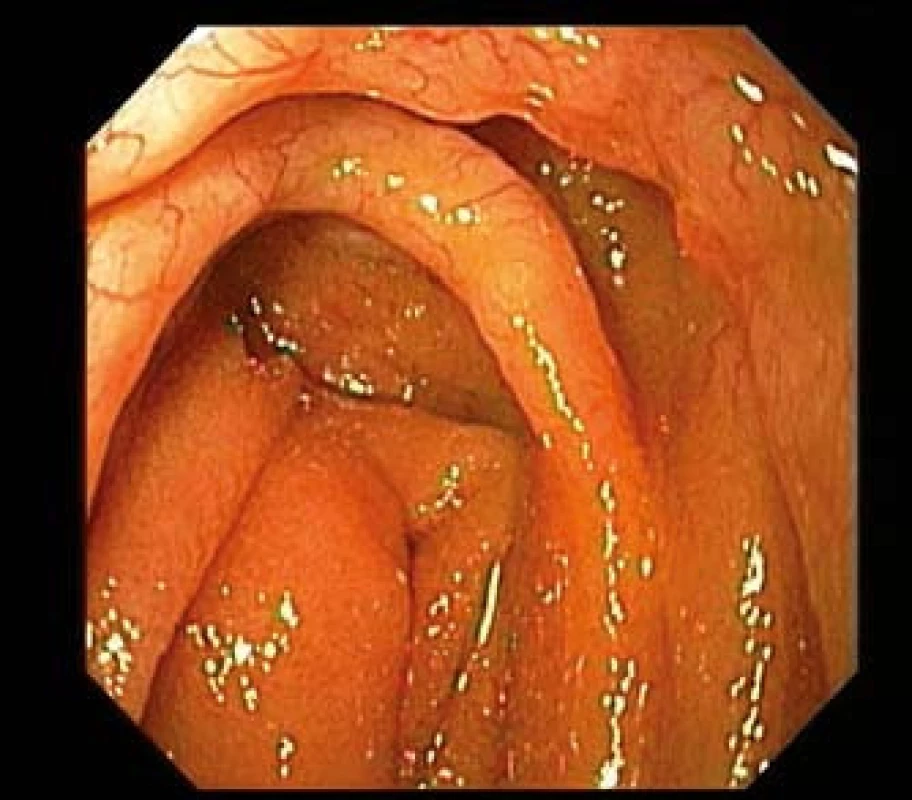 MALT lymfom jejuna u 43letého pacienta s Crohnovou chorobou. Gastroskop zavedený do oblasti duodenojejunálního přechodu prokazuje infiltraci slizničních řas s zřetelnou patologickou neovaskularizací.
Fig. 3. MALT lymphoma of the jejunum in 43-year-old patient with Crohn's disease. Gastroscope introduced in duodeno-jejunal transition shows infiltration mucosal folds with distinct pathological neo-vascularization.