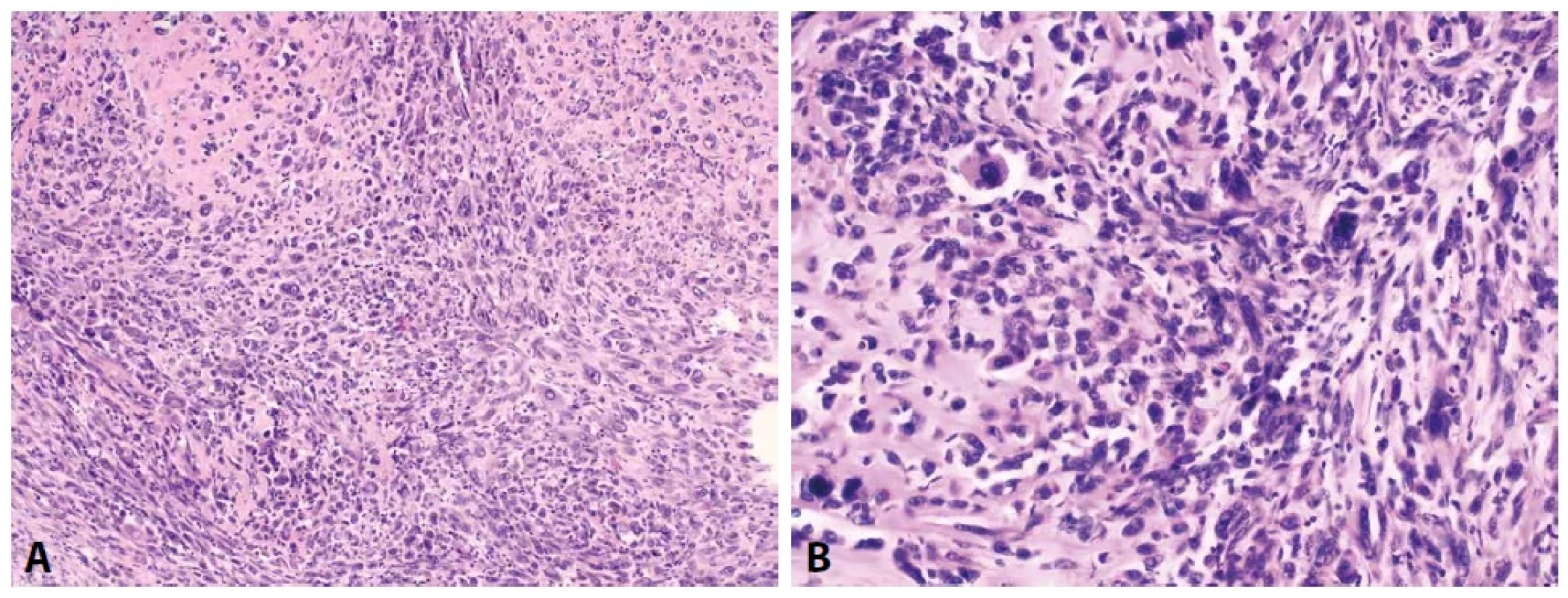 Nález v prsu, případ 2 – invazivní karcinom NST přecházející v metaplastický karcinom. (A hematoxylin eozin, zvětšeno 100x, B jaderný detail, hematoxylin eozin, zvětšeno 200x).