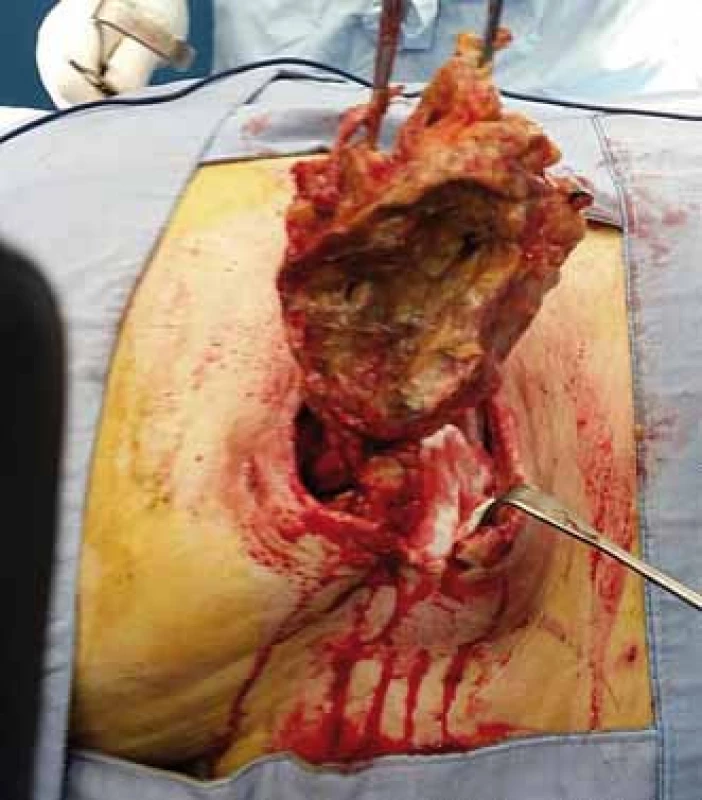 Exstirpace pseudocysty dekubitu.
Fig. 2. Extirpation of pseudocyst of decubitus (pressure ulcer).