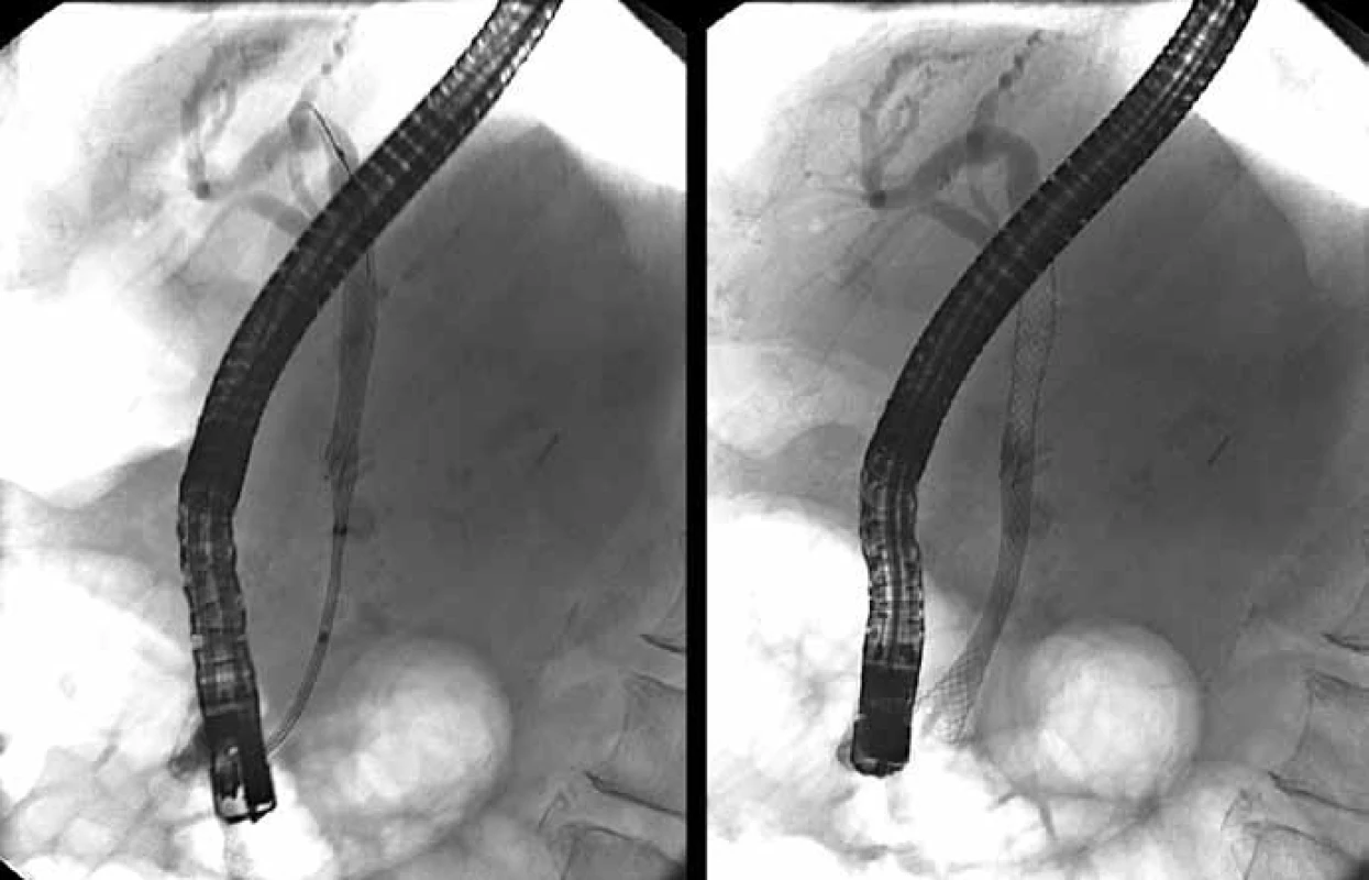 Zavedenie biliárneho plne povlečeného samorozťažného kovového stentu.
Fig. 5. Insertion of biliary fully covered self-expandable metallic stent.