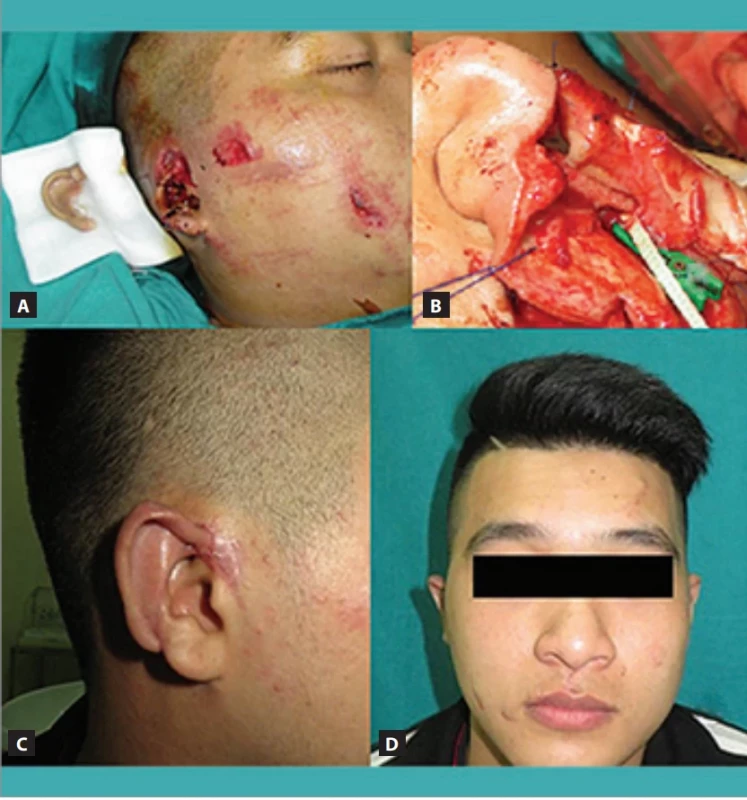 Amputated ear replantation. (A) Part of the right ear was amputated; (B) posterior auricular artery anastomosis; (C) use of leeches to treat venous congestion; (D) long-term results.
