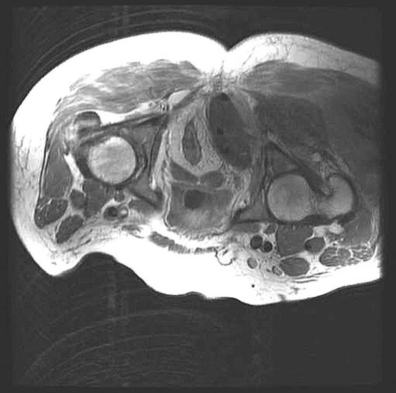 MR obraz rozsáhlé abscesové kolekce pararektálně vpravo a v gluteálních svalech vpravo
Fig. 1. MR view of the extensive abscess collection in a right pararectal area and in a right gluteal muscles