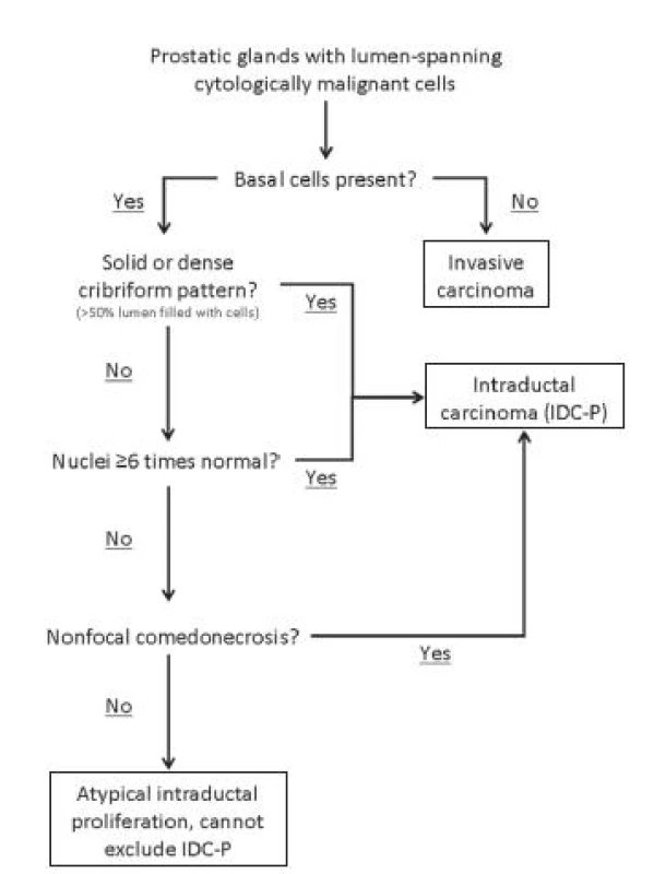 Schematic representation of the diagnostic criteria for intraductal carcinoma proposed by Guo and Epstein (36).