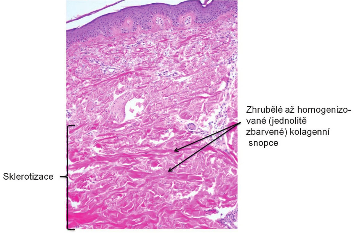 Histologický nález biopsie kůže z dorza zápěstí levé ruky. (2004, autor snímku: prof. MUDr. J. Štork, CSc., Dermatovenerologická klinika 1. LF UK v Praze)