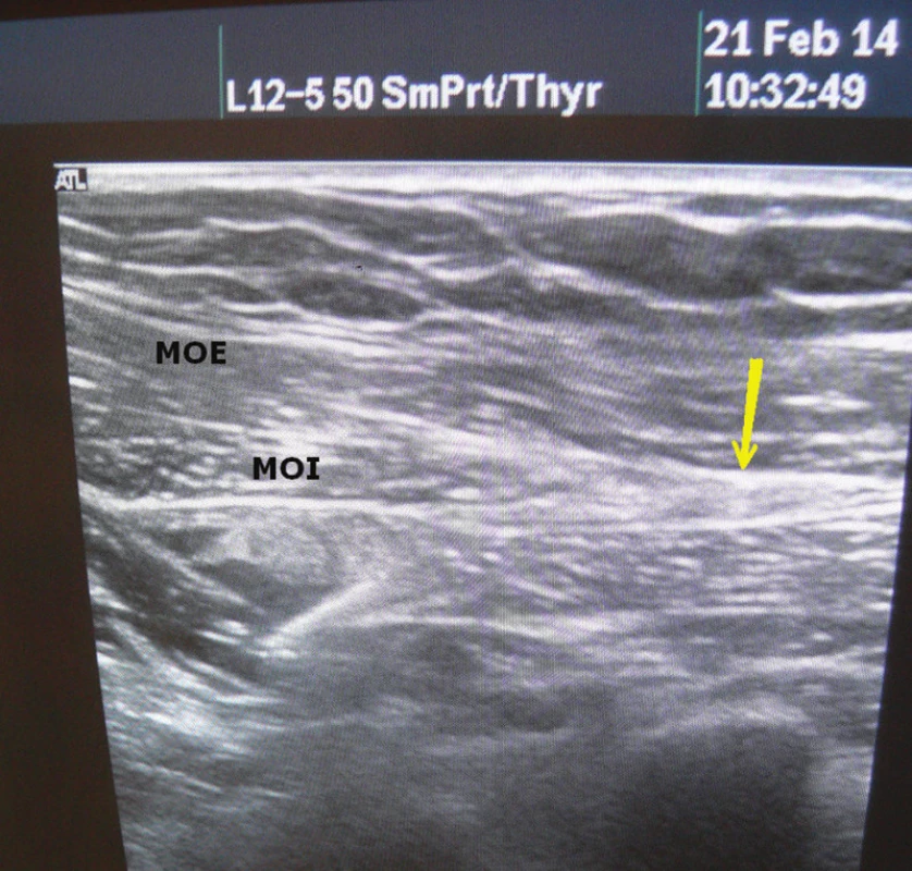 Ultrazvuk břišní stěny
Žlutá šipka – místo pro komponent separaci.
Fig. 8: Ultrasound of the abdominal wall
Yellow arrow – level of component separation.