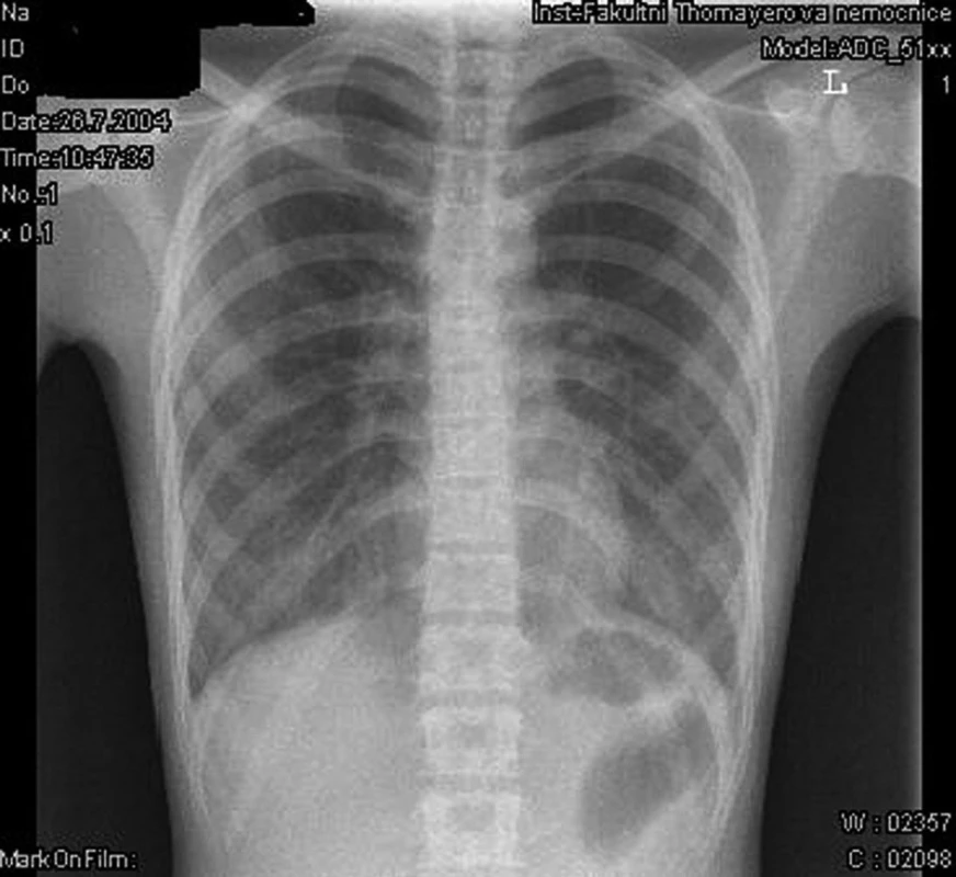 Rentgenový snímek plic.
Fig. 1. X-ray picture of the lung (chest).