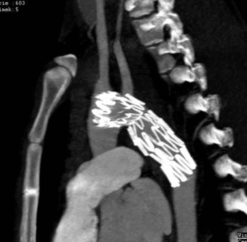 Kontrolní snímek 3 měsíce po implantaci stentgraftu
Fig. 3: Control X-ray picture 3 months after stent graft implantation