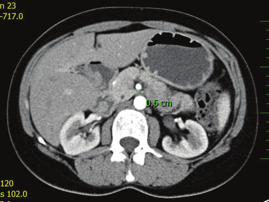 V axiální rovině CT vyšetření je zobrazena komprese duodena mezi abdominální aortou a horní mezenterickou tepnou, se sníženou aortomezenterickou vzdáleností na 0,6 cm
Fig. 2: Axial reconstruction of CT images showing compression of the duodenum between the abdominal aorta and the superior mesenteric artery, the aortomesenteric distance
is reduced to 0.6 cm