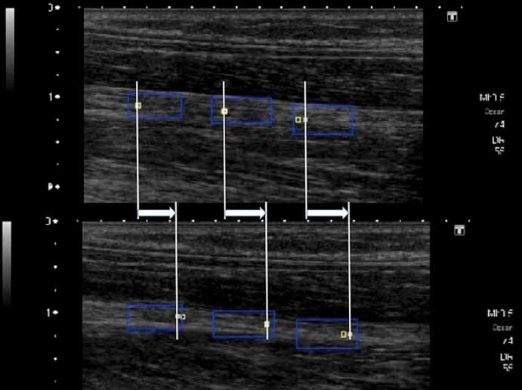 Rozdíl polohy nervus medianus během longitudinálního pohybu mezi maximální polohou distálně (horní část obrázku, extenze prstů) a maximálním vychýlením proximálně (dolní část obrázku, flexe prstů) při testovacím pohybu (modrý obdélník – měřená oblast, bílý a žlutý čtvereček – sumární pozice, bílá šipka – celkový posun nervu).