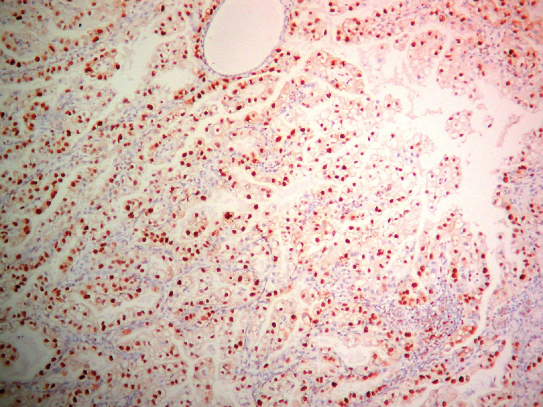 Detekcia PCNA v SvC. ABC- Px, 100×.