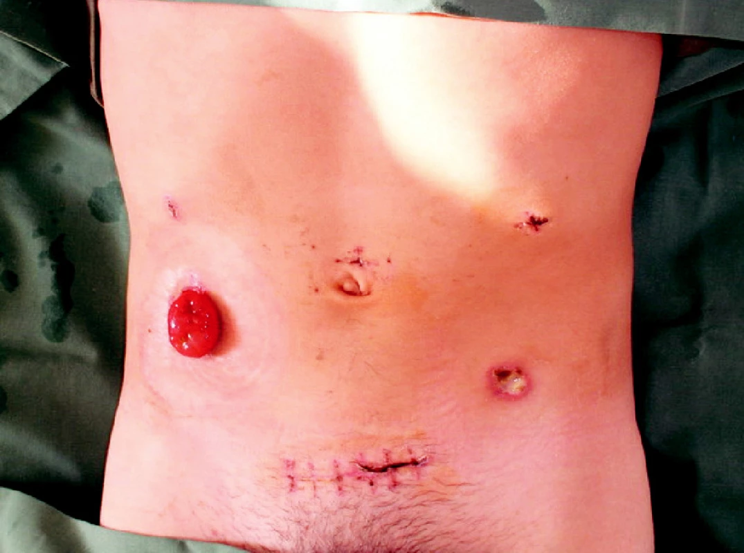 Pacient s FAP po laparoskopickej proktokolektómii s IPAA
Fig. 2. Patient with FAP after restorative proctocolectomy