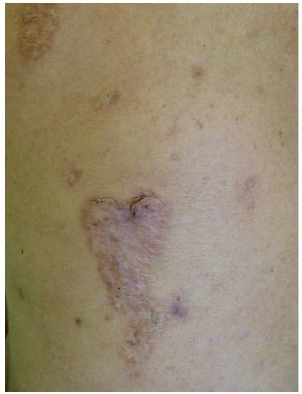 Kribriformní jizvy po zhojeném pyoderma gangrenosum u pacientky s PASH