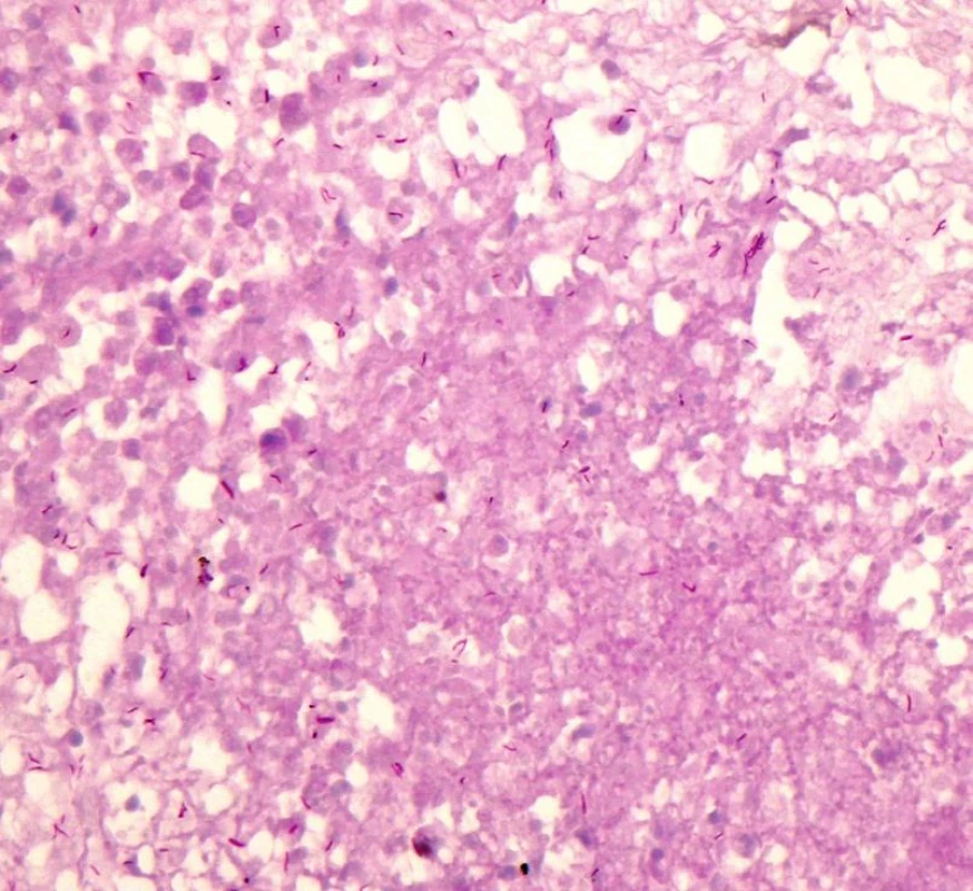 TB bacterium in histological finding. HE, magnified 400x