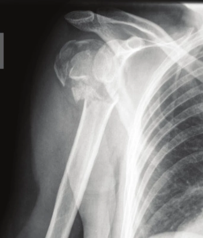 RTG obraz implantace hemiartroplastiky. Předoperační RTG snímek