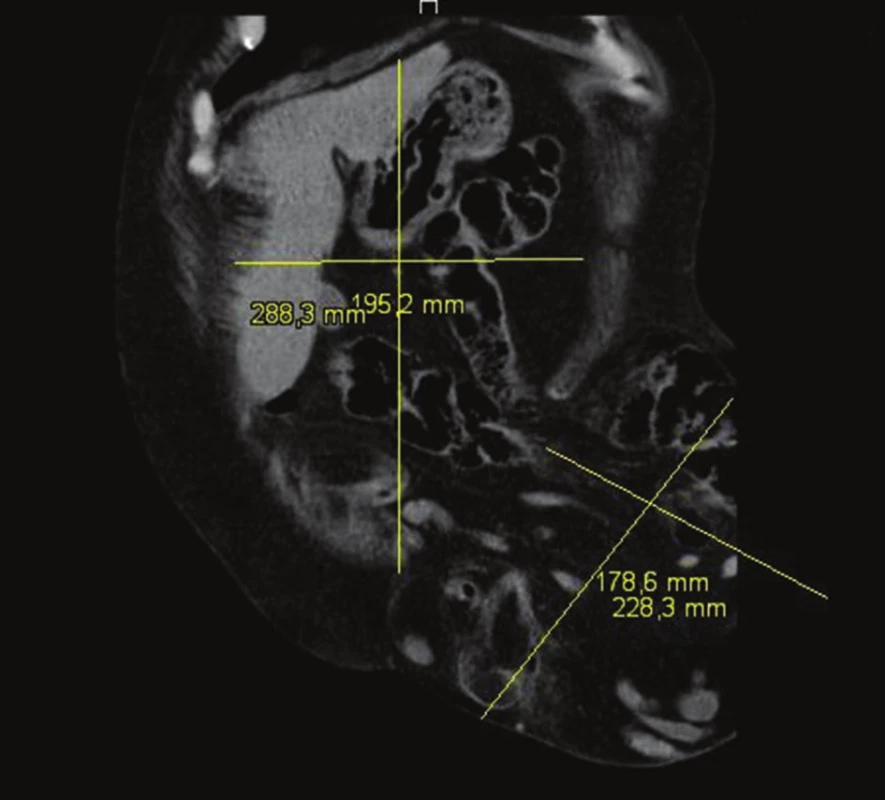 CT volumetrie (frontální část)
Fig. 5: CT volumetry (coronal part)