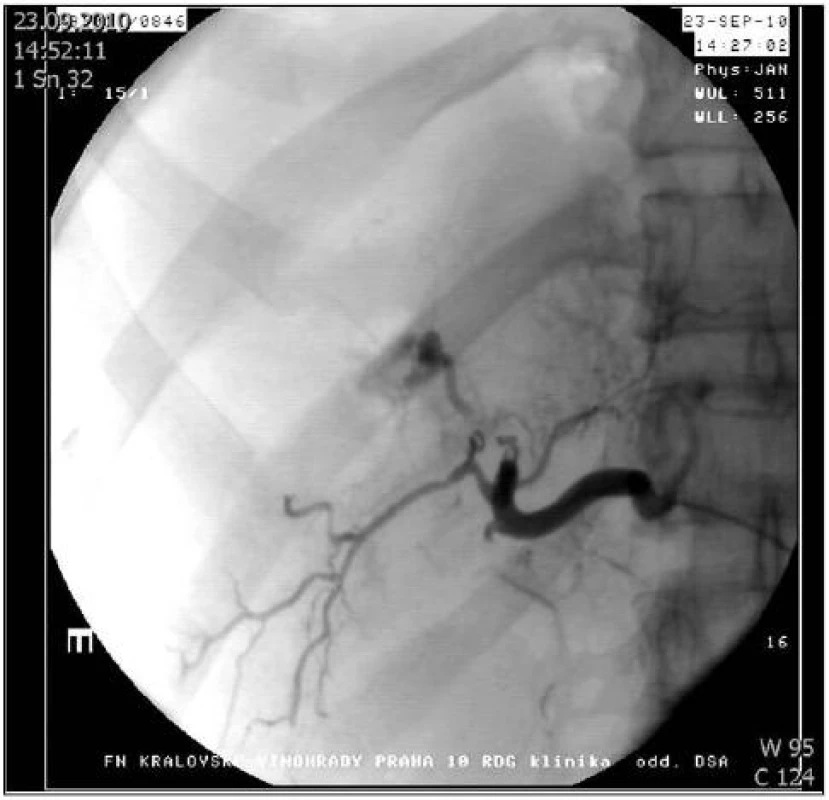 Arteriografie jaterní tepny: Arteriovenózní píštěl ošetřena embolizací
