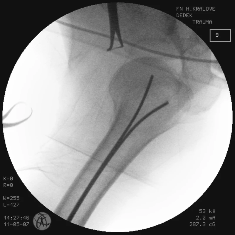 RTG obraz po primární zavřené repozici zlomeniny proximálního humeru a transfixaci zlomeniny 2 K-dráty u pacienta č. 2
Fig. 5. X-ray view following primary closed proximal humeral fracture repositioning and after the fracture transfixation with 2K wires in the patient No. 2