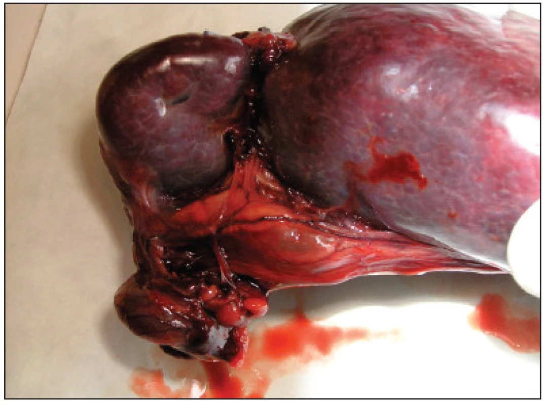 Torzia lienálnych ciev s trombami.
Fig. 8. Torsion of splenic arteries with thrombus