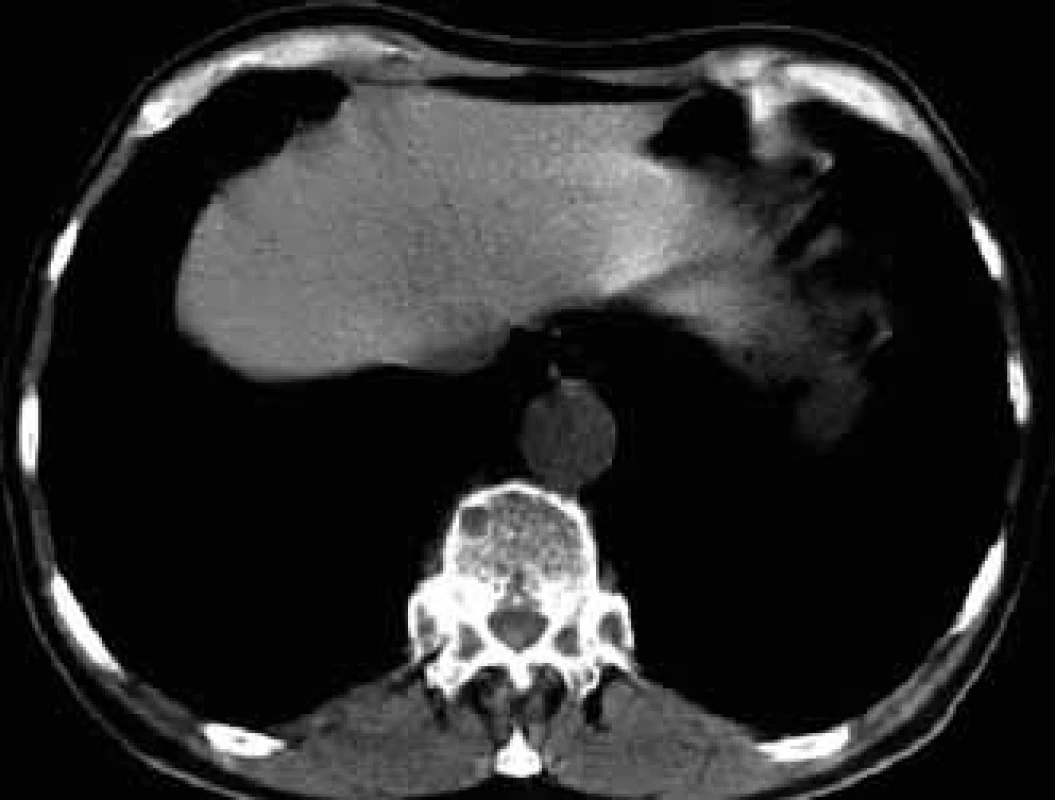 A smaller osteolytic deposit in a thoracic vertebra and rib head on the left in CT image.