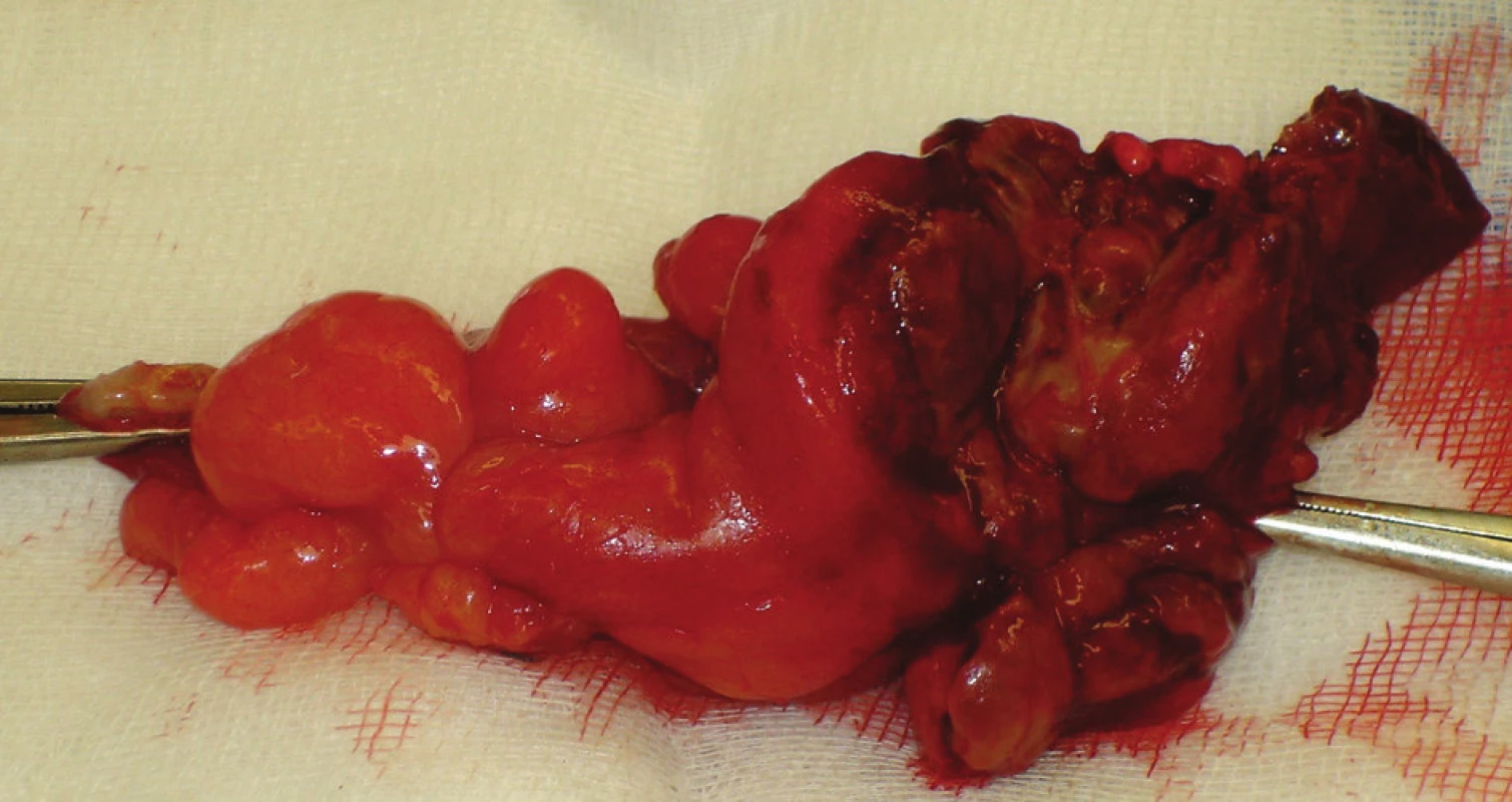 Preparát apendixu s perforací apexu
Fig. 3. Preparation of the appendix with its apex perforation