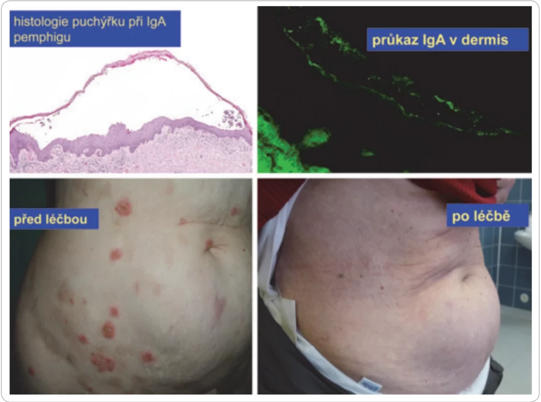 Pemphigus u pacientky s IgA-myelomem.