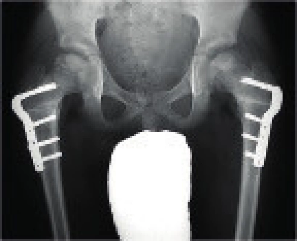 RTG pánve pacienta po oboustranné varizační osteotomii.
Fig. 6. Pelvis X-ray of a patient after a bilateral varus osteotomy.