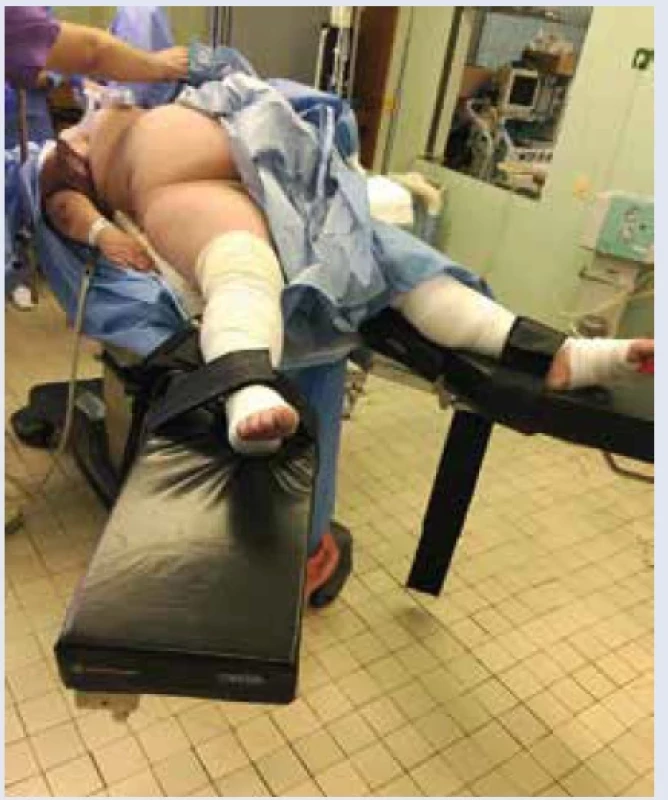 Príprava k sekcii obéznej pacientky. Snímka: Archív II. gynekologicko-pôrodnickej kliniky FNsP F. D. Roosevelta, Banská Bystrica