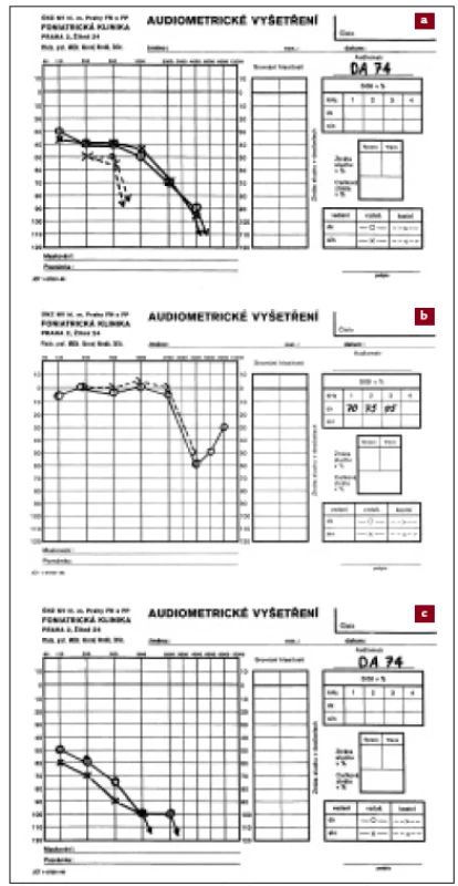 a, b, c. Různé typy percepčních vad sluchu – tónové audiogramy (údaje na ose x v Hz, na ose y v dB). Maximum sluchových ztrát je v oblasti vyšších frekvencí.