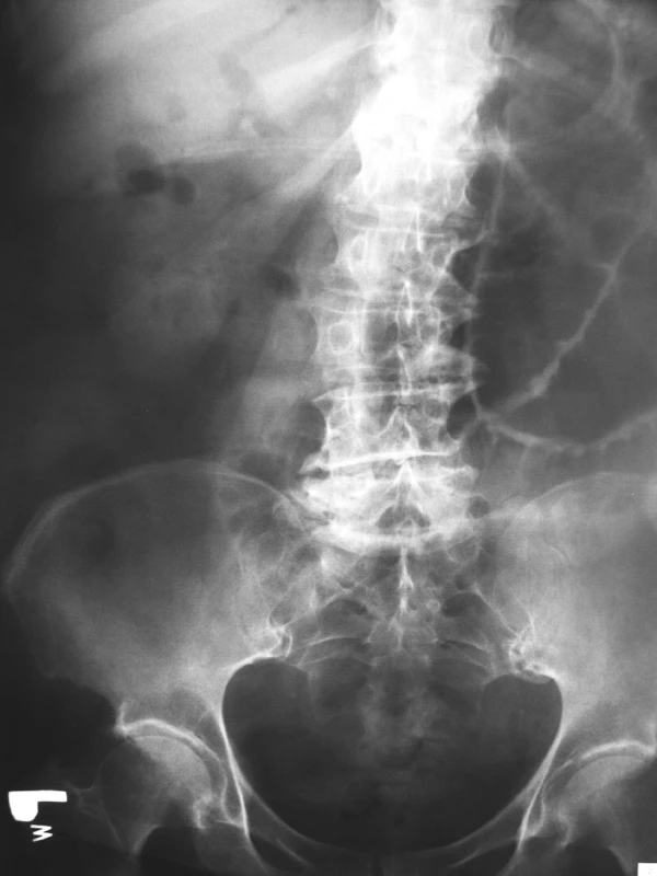 RTG abdomenu v stoji – aerobília (čierna šípka)
Pic. 3. X ray of abdomen in standing position – aerobilia (black arrow)