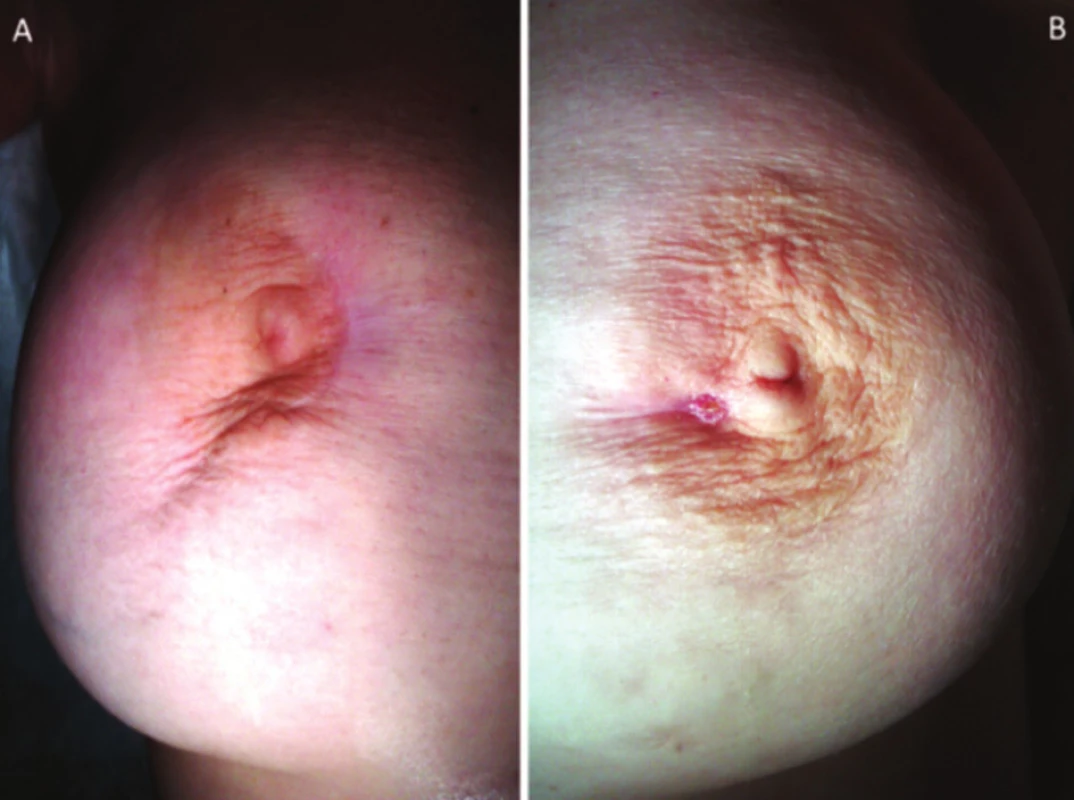 a) pravý prsník – prítomná retrakcia bradavky, periareolárne prítomná jazva po predchádzajúcich incíziách abscesu, b) ľavý prsník – prítomná periareolárna fistula ductus lactiferi a jazva po predchádzajúcich incíziách abscesu
Fig. 1: a) right breast – presentation of the nipple retraction, a periareolar scar after previous incisions of abscess; b) left breast – presentation of the periareolar fistula of lactiferous duct and a scar after previous incisions of abscess