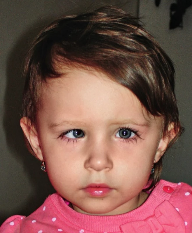 Paréza n. VI.
Fig. 1. Abducens nerve palsy.