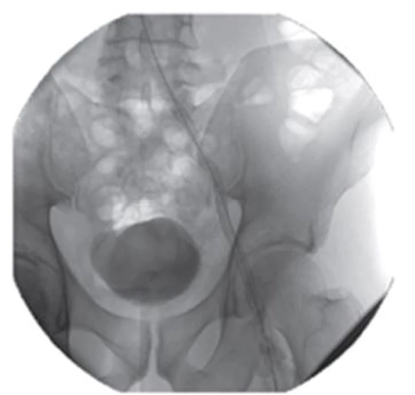 Stenting pánevního řečiště
Fig. 4: Stenting of pelvic vasculature