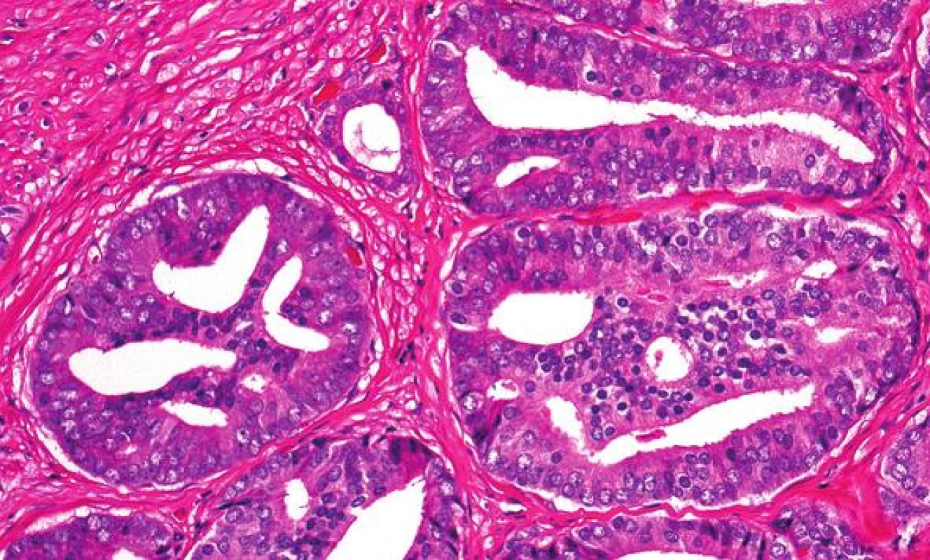 All cribriform cancer glands are graded as grade 4, including those small ones with smooth counter.