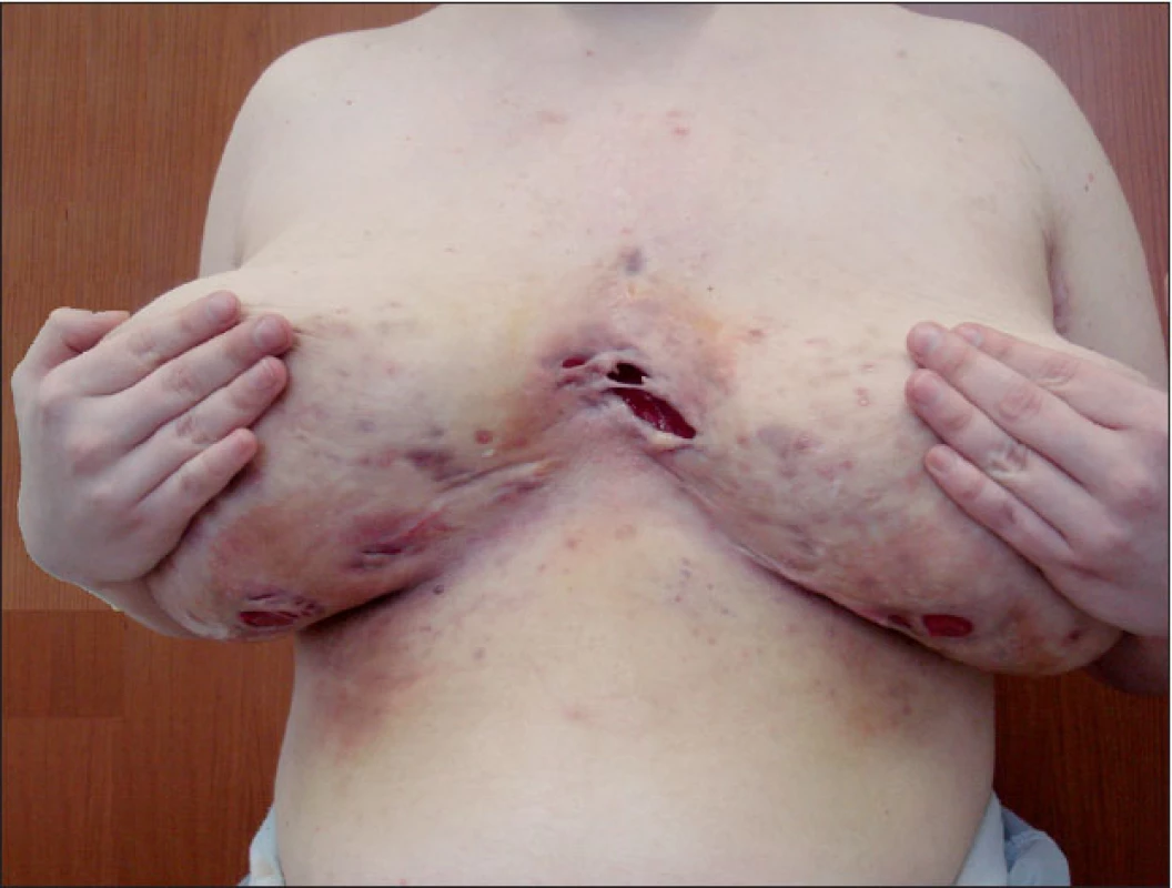 Intermamární a submamární postižení hidradenitis suppurativa
